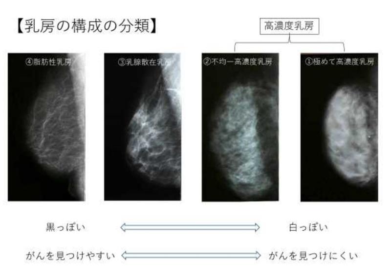 出典:厚生労働科学研究費補助金「乳がん検診における乳房の構成(高濃度乳房を含む)の適切な情報提供に資する研究」2017年度